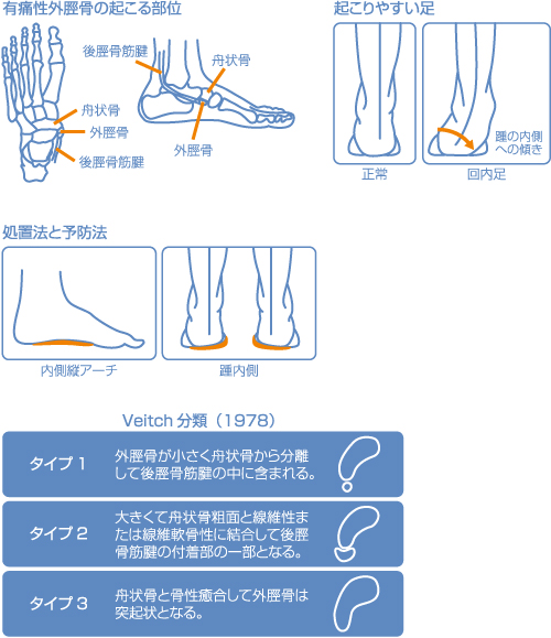 痛い の 下 内 くるぶし