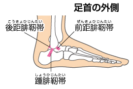 反 捻挫 内