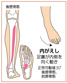 反 捻挫 内